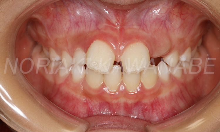 前歯のすき間、前歯が出ている（8歳 男児）