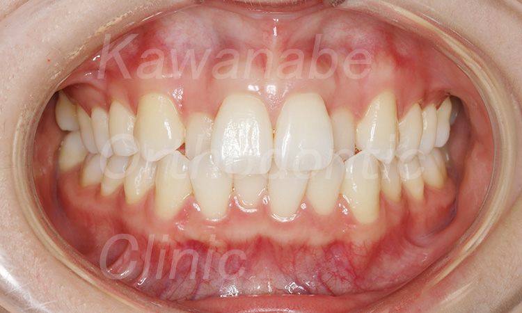 前歯がガタガタ（23歳　女性）