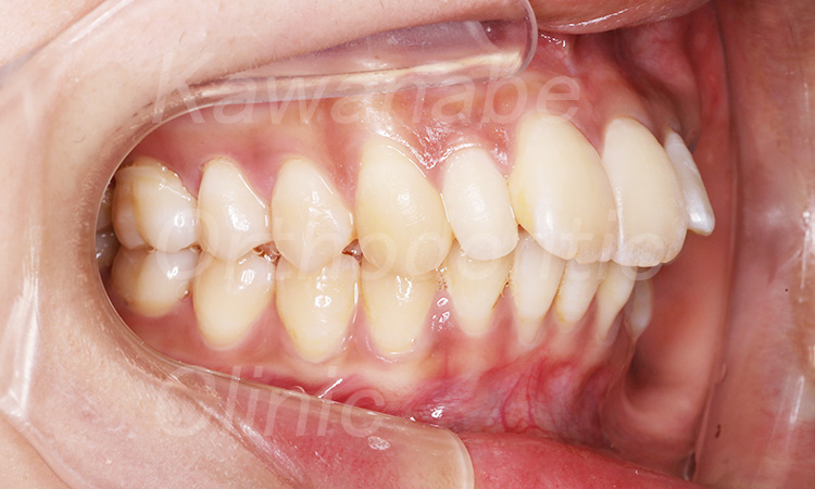 前歯と口元が出ている（26歳 女性）