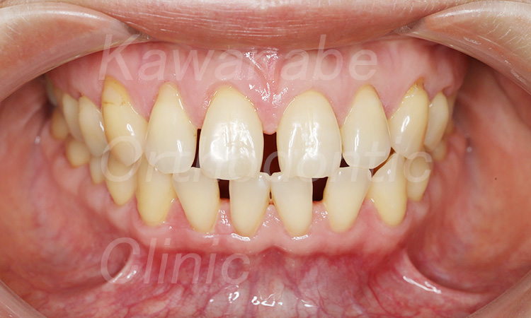 すきっ歯(47歳 女性)