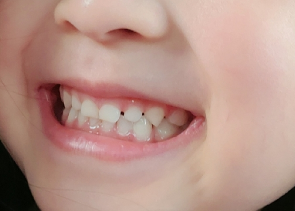 子供の歯並び矯正