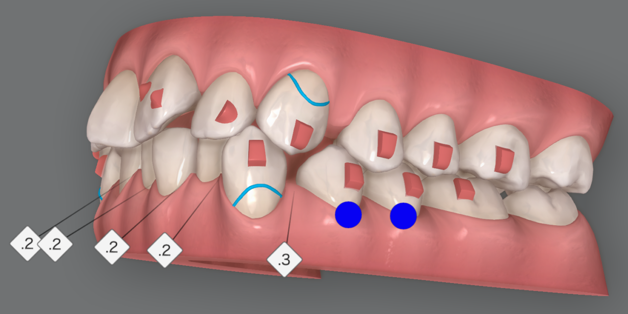 非抜歯・大臼歯遠心移動症例