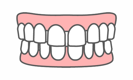 歯と歯の間に隙間がある「すきっ歯・空隙歯列」
