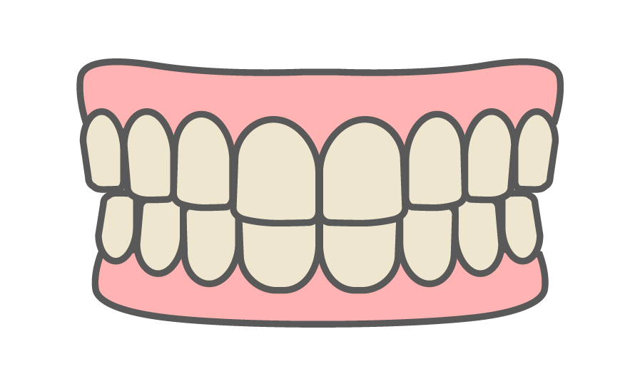歯の黄ばみ・着色汚れ